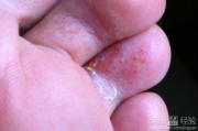 脚上起小水泡还很痒,原因与处理方法-皮肤问题解析