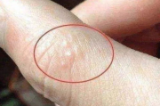 脚底水泡瘙痒的原因与解决方法-皮肤问题深度解析