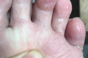 脚上起小水泡还很痒？揭秘背后的原因与应对策略！