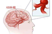 血管神经性头痛：症状识别与治疗策略